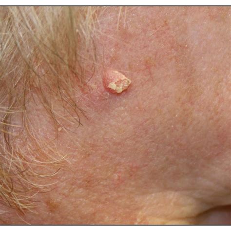 Cancerous Skin Growths: Causes, Types, and Treatment