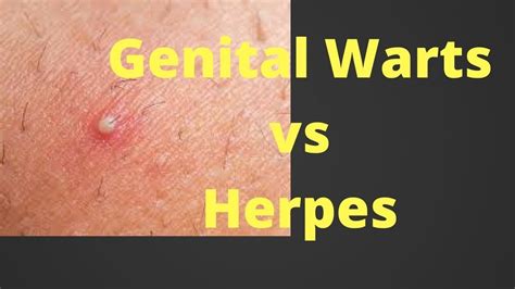 Female Genital Herpes Pictures: Visual Guide to Understanding